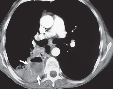 Fig. 64.3, Acute aspiration pneumonia with abscess formation in an alcoholic man. A contrast-enhanced CT shows consolidation in the superior segment of the right lower lobe. An abscess (arrows) with an air-fluid level and an irregular poorly defined wall is visible within the consolidation.