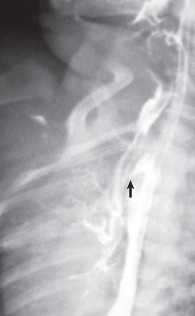 Fig. 64.5, Tracheoesophageal fistula in an infant with respiratory difficulty after feeding. Esophagram shows a fistula (arrow) between the trachea and the middle esophageal segment. Note contrast within the right lower lobe bronchi.