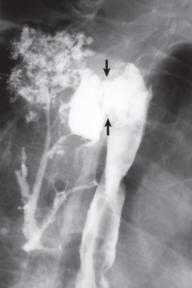 Fig. 64.6, Postradiation pulmonary esophageal fistula in a man with advanced esophageal carcinoma. Esophagram reveals a fistula (arrows) between the esophagus and the lung parenchyma. Note the retrograde alveolar filling by contrast material.