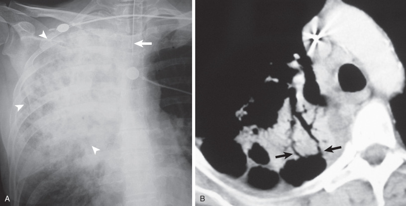 Fig. 64.7, Acute aspiration pneumonia in a man with fever and putrid sputum who aspirated a large amount of vomitus. (A) Anteroposterior chest radiograph shows extensive heterogeneous right upper lobe consolidation (arrowheads) . Note endotracheal tube (arrow) . (B) Close-up view of the corresponding CT demonstrates multiple bronchopleural fistulas (arrows) likely from necrotizing pneumonia.