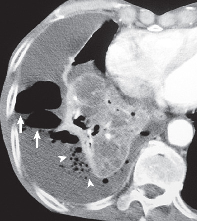 Fig. 64.8, A man with aspiration pneumonia, fever, and chest pain. Contrast-enhanced CT demonstrates right lower lobe heterogeneous consolidation and a large empyema containing air-fluid levels (arrows) , scattered air bubbles (arrowheads) , and enhancing visceral pleural thickening.