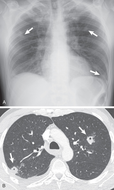 Fig. 64.9, An alcoholic with fever, putrid sputum, and pyorrhea. (A) Anteroposterior chest radiograph shows bilateral ill-defined nodules (arrows) . (B) Axial CT demonstrates multiple cavitated nodules (arrows) . A small right pleural effusion is also visible.