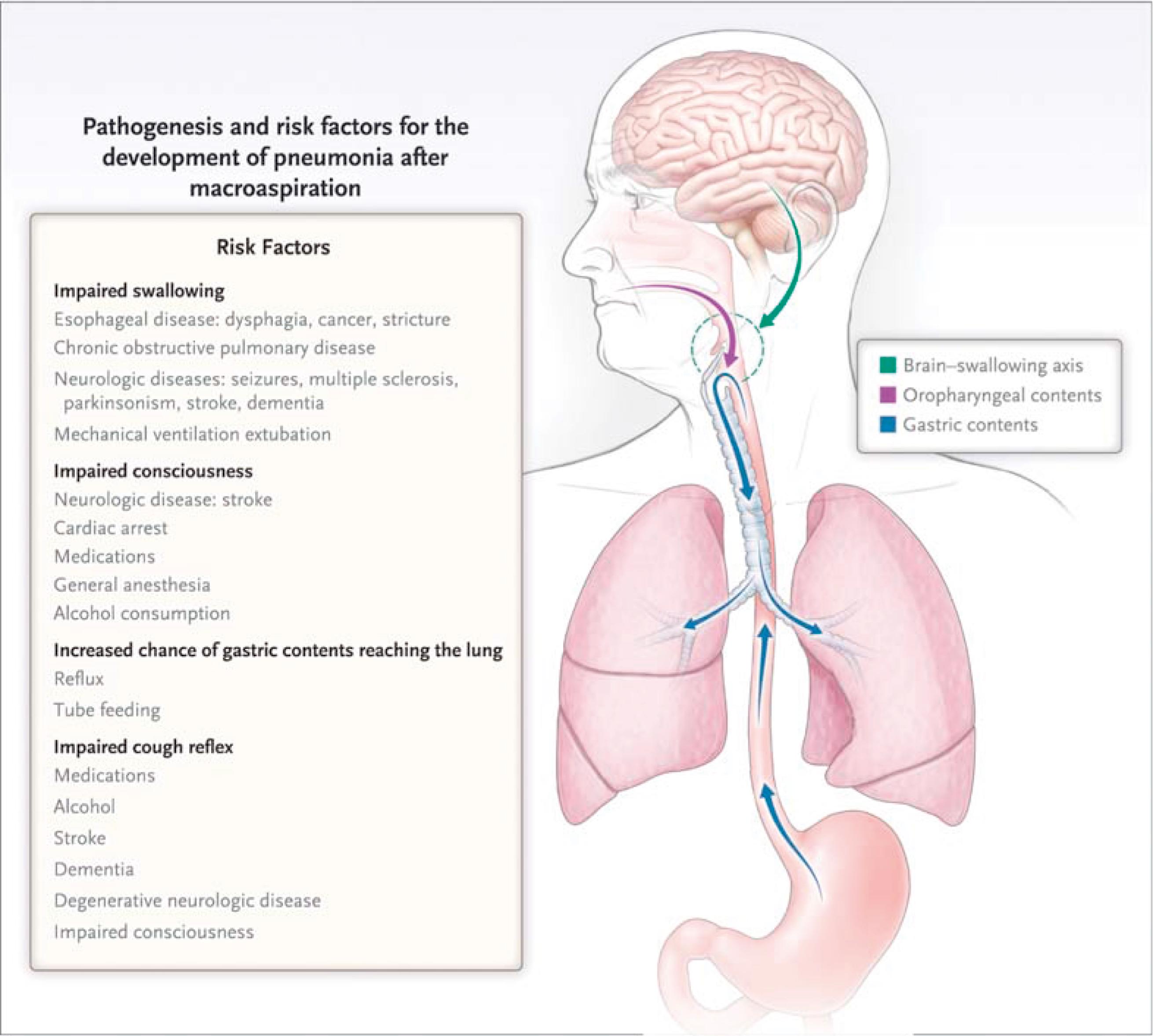 Fig. 29.1, Pathogenesis of and risk factors for pneumonia after macroaspiration. Macroaspiration can occur as a result of abnormalities in the swallowing mechanism or altered swallowing due to dysfunction of the central nervous system. In patients with these disorders, oropharyngeal or gastric contents can enter the lung. An impaired cough reflex increases the likelihood that aspirated material will reach the lung. Shown are the disease processes that serve as risk factors for macroaspiration by impairing consciousness, swallowing, and cough and by increasing the chance that gastric contents will reach the lung.