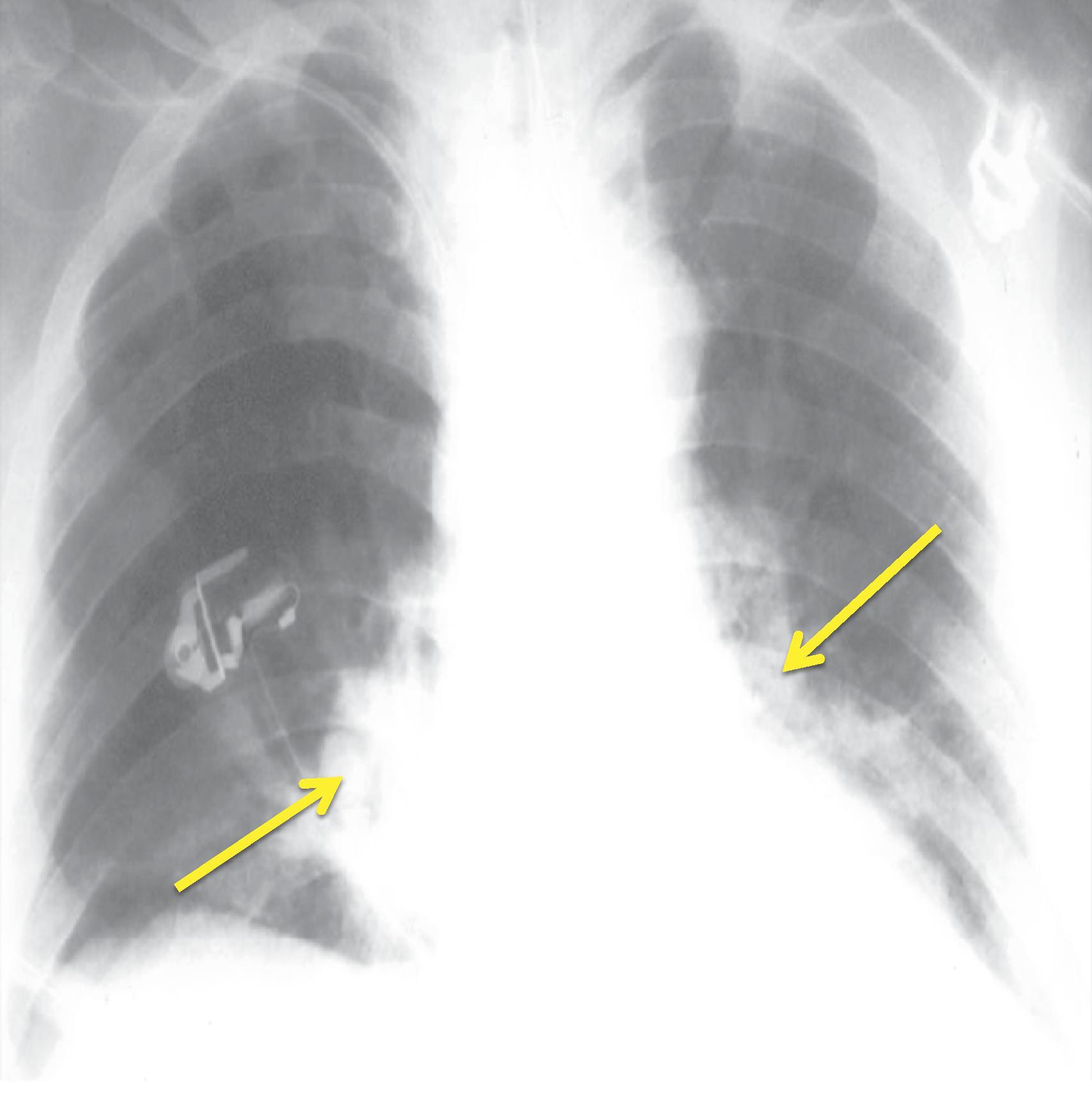 Fig. 14.1, Chest x-ray performed after tracheal intubation. Pulmonary infiltrates are seen in the dependent parts of the lungs (arrows) .