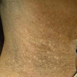 FIGURE 50.1, Poikiloderma on the neck of an older-aged woman.