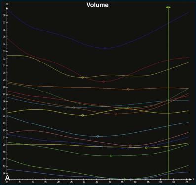 Figure 12-3, Time-volume curves in a patient with impaired left ventricular systolic function. A, The time-volume curves are relatively flat, with little change in absolute volume throughout the cardiac cycle, indicating severe left ventricular systolic dysfunction. B, The amplitude of the normalized volume curves is greater, making the minimum volume point easier to identify. The dispersion of the minimum volume points is greater compared with the patient with normal left ventricular systolic function. This indicates a high systolic dyssynchrony index and therefore significant dyssynchrony. The mean minimum volume is approximately 85% of the maximum, suggesting an ejection fraction in the region of 15%.