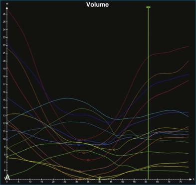 Figure 12-4, A, In this patient with ischemic left ventricular systolic dysfunction, the time-volume curves are relatively flat, although the U shape of some curves is preserved, suggesting regional wall motion abnormalities. B, When the normalized volume curves are inspected, the minimum volume of the septal and anteroseptal curves ( green and light blue curves ) occur at the beginning of systole. This is consistent with a septal flash.