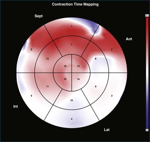 Figure 12-6, Typical static map in a dyssynchronous patient showing U -shaped earliest color transition predominantly in the basal lateral and inferolateral segments, suggesting a predominant left-to-right activation. The activation also is slower than normal; a large part of the map remains red (see Video 12-4). Ant, anterior; Int, interior; Lat, lateral; Sept, septal.