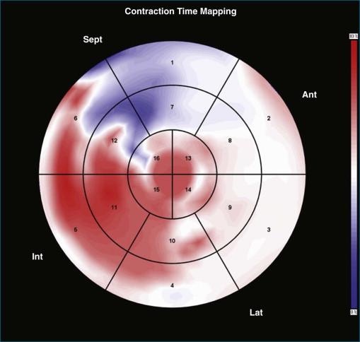 Figure 12-7, Atypical static map showing U -shaped right-to-left activation, with first color transition predominantly in the basal anteroseptal and anterior segments (see Video 12-5). Ant, anterior; Int, interior; Lat, lateral; Sept, septal.