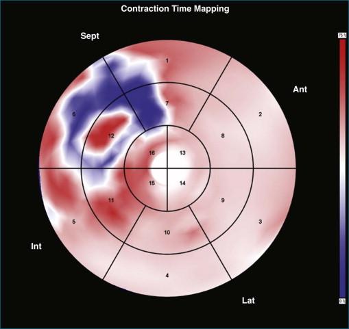 Figure 12-8, A clear septal flash is seen ( dark blue ). This is again associated with a typical predominant left-to-right transition; the next activation is seen in the basal lateral and inferolateral segments ( white ) (see Video 12-6). Ant, anterior; Int, interior; Lat, lateral; Sept, septal.