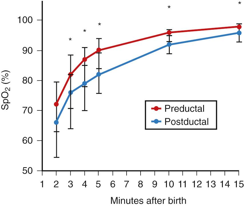 Fig. 63.2, A rapid postnatal rise in oxygenation occurs during the normal fetal to neonatal transition. Preductal and postductal levels measured by way of pulse oximetry showed significantly lower postductal than preductal levels at 3, 4, 5, 10, and 15 minutes. * P < .05. (Mariani G, et al. Pre-ductal and post-ductal O 2 saturation in healthy term neonates after birth. J Pediatr. 2007;150:418.)