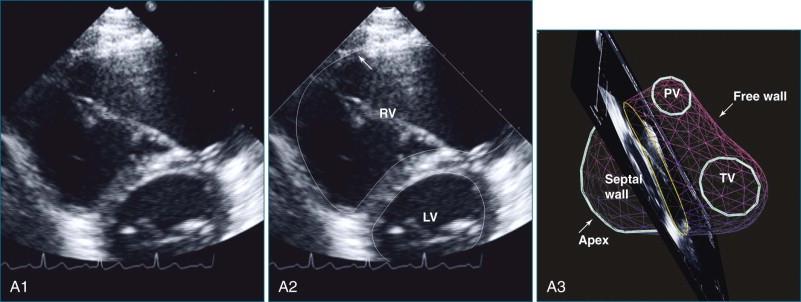 Figure 13-2, Visualization of the right ventricle (RV) in parasternal views. All views are shown in original form ( left ) with annotation ( center ), and as a three-dimensional reconstruction ( right ) of the RV illustrating the anatomic position of the view plane and the RV contour (in yellow ). The patient has tetralogy of Fallot with wide-open pulmonary regurgitation after repair; the RV end-diastolic volume index is 132 mL/m 2 . A1-3, RV-centered short-axis (SAX) view at mid-level angulated to visualize the free wall ( arrow ) within the sector. B1-3, Basal SAX view angulated to visualize RV inflow. C1-3, Basal SAX view angulated to visualize RV outflow. D1-3, Modified SAX view to visualize RV outflow. E1-3, RV centered long-axis (LAX) view. F1-3, LAX view rotated to visualize RV inflow. G1-3, LAX view rotated to visualize RV outflow. Ao , aorta; LV , left ventricle; PA , pulmonary artery; PB , parietal band; PV, pulmonary valve; TV, tricuspid valve; RA , right atrium.