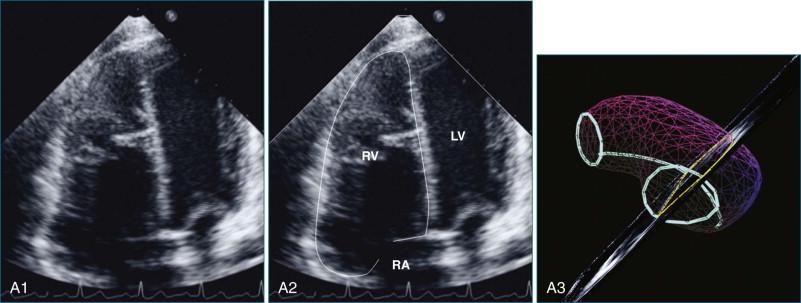 Figure 13-3, Visualization of the right ventricle (RV) in apical views shown in original form ( left ) with annotation ( center ), and as a three-dimensional reconstruction ( right ) of the RV illustrating the anatomic position of the view plane and the RV contour (in yellow ) A1-3, RV-centered four-chamber (4C) view. B1-3, Sweeping anteriorly from the 4C view reveals the RV free wall between the valves. C1-3, Acquisition of the 4C view from a medial position may improve visualization of the apical free wall ( arrow ). D1-3, The anterior sweep from the 4C view, taken from a medial transducer position, may improve visualization of the free wall between the valves. E1-3, View of both inflow and outflow regions. The apex ( not seen ) is at the upper right. LV, left ventricle; PA, pulmonary artery; PB, parietal band; RA, right atrium.
