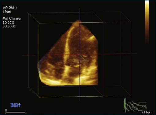 Figure 13-5, Video image of a normal echocardiogram from the apical four-chamber view. The area of the right ventricle is smaller than that of the left ventricle on visual inspection, in accordance with their end-diastolic volume indexes (86.3 mL/m 2 and 99.5 mL/m 2 , respectively). The right ventricular ejection fraction is 51% (see Video 13-1).