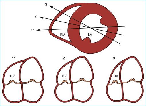 Figure 13-6, The recommended apical four-chamber (A4C) view with focus on the right ventricle ( RV, 1* ) and the sensitivity of RV size with angular change ( 2, 3 ) despite similar size and appearance of the left ventricle ( LV ). The lines of intersection of the A4C planes ( 1*, 2, 3 ) with a mid–LV short axis are shown above with corresponding A4C views below.