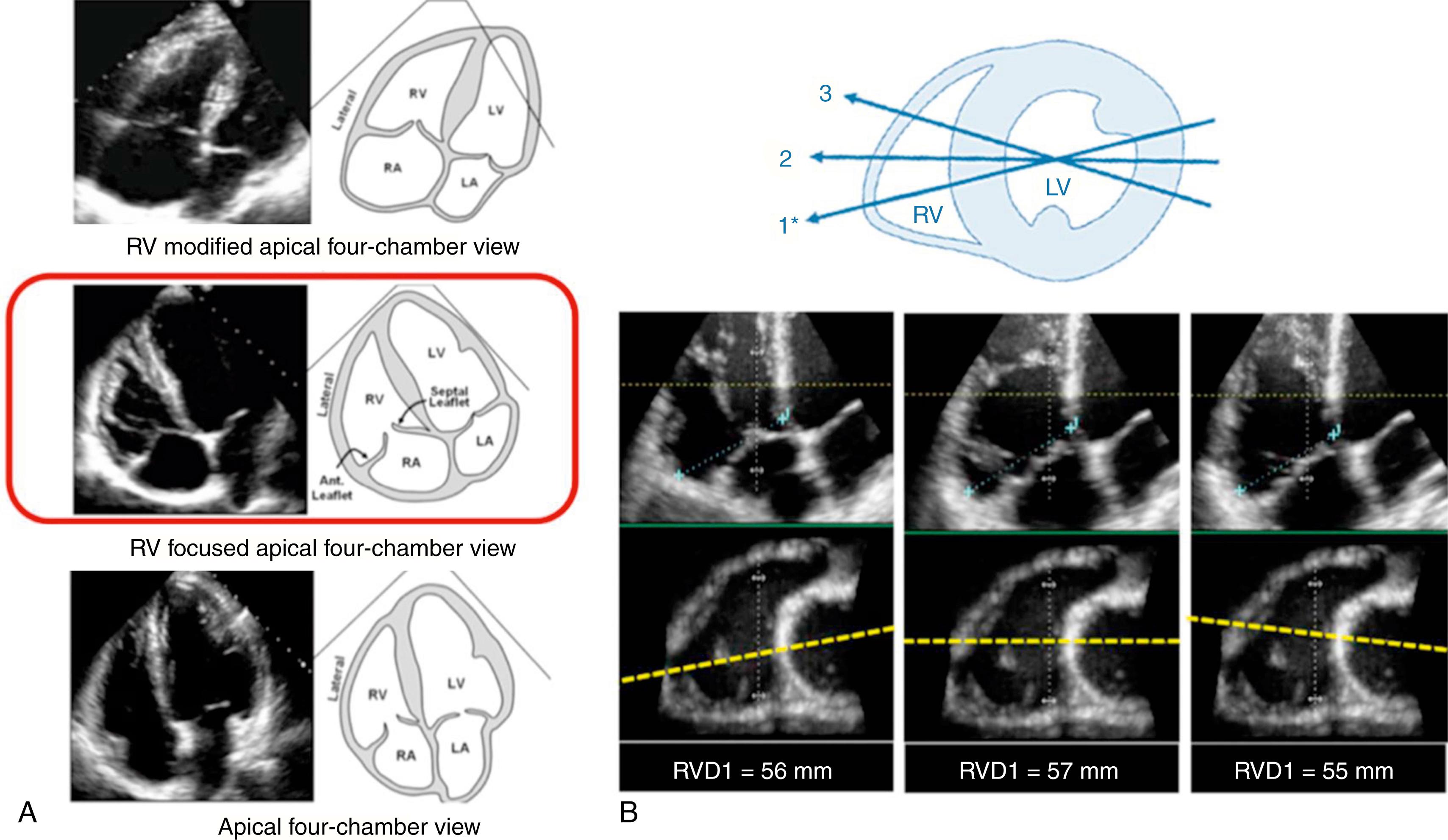 Figure 30.1, A, Three apical views of the right ventricle (RV): the RV-modified, RV-focused, and standard apical four-chamber views. B, The rationale for using the RV-focused view in ensuring the maximal dimension by demonstrating the relationship between rotation of the transducer and the RV measurement. LA, Left atrium; LV, left ventricle, RA, right atrium; RVD1, basal RV dimension.