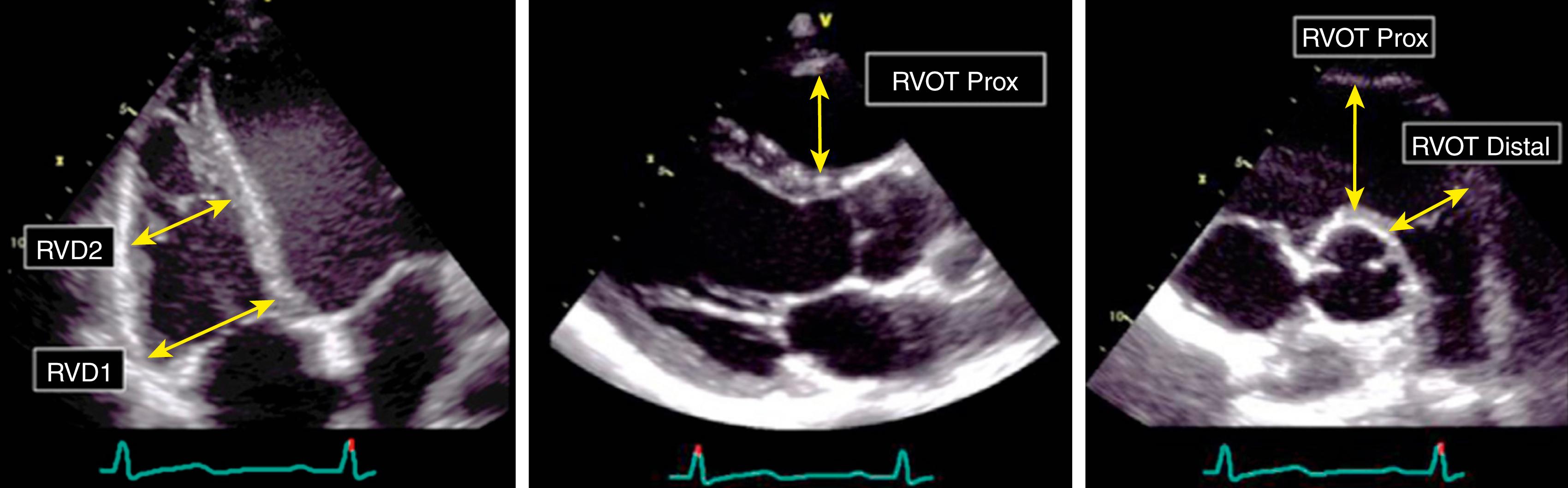 Figure 30.2, Right ventricular dimensions demonstrated from the right ventricle–focused view, the proximal right ventricular outflow tract (RVOT) from the parasternal long-axis view, and the proximal (Prox) and distal RVOT in the parasternal short-axis view. RVD1, basal RV dimension; RVD2, mid RV dimension.