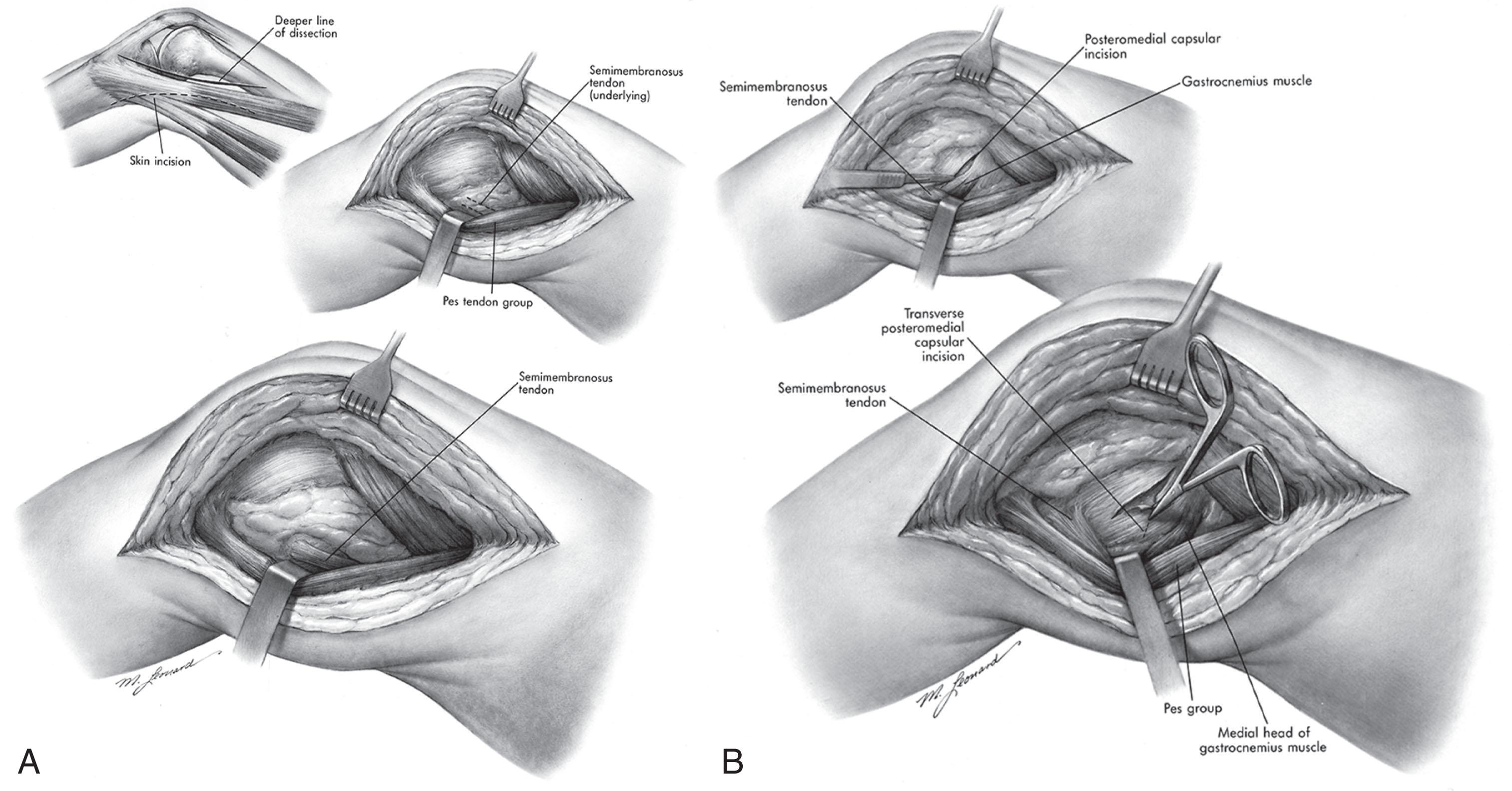 Fig. 4.3, (A) An alternative medial/posteromedial arthrotomy used for removal of posteromedial osteophytes in the case of limited intraoperative flexion. (B) Deeper dissection in the medial/posteromedial arthrotomy used for removal of posteromedial osteophytes in the case of limited intraoperative flexion.