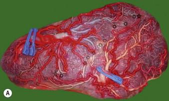 FIGURE 9-1, (A) Typical placenta of an uncomplicated monochorionic diamniotic twin pregnancy after colour injection and removal of the amniotic membranes. Delivery was at 36 weeks, twin 1 weighed 2665 g and twin 2 weighed 2625 g. The placenta is equally divided between both twins and both cords have an eccentric insertion in the placental disc. There are multiple vascular anastomoses: one small bidirectional arterioarterial anastomosis (full star) and venovenous anastomosis (dotted star) and multiple unidirectional arteriovenous anastomoses from twin 1 to twin 2 (full circle) and oppositely directed venoarterial anastomoses from twin 2 to 1 (dotted circle). (B) Typical placenta of an uncomplicated dichorionic twin pregnancy with fusion of the placental discs. There are no vascular anastomoses between the twins and the chorion forms part of the intertwin septum (arrow).