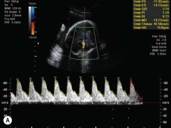 FIGURE 9-12, (A) Elevated middle cerebral artery peak systolic velocities in the ex-recipient at 27 weeks of a pregnancy that underwent fetoscopic laser surgery for twin–twin transfusion syndrome at 19 weeks and was diagnosed with twin anaemia polycythemia sequence 7 weeks later. The week before two intrauterine transfusions were administered for haemoglobin levels of 3.1 g/dL and 4.9 g/dL. Because of the rapid recurrence of the anemia and because of ruptured membranes, it was decided to deliver the twins. Haemoglobin at birth was 7 g/dL. There was one small missed arteriovenous anastomosis next to the site of the trocar entry and so invisible at the time of laser. (B) Decreased middle cerebral artery peak systolic velocities in the corresponding ex-donor at 27 weeks. Haemoglobin at birth was 22 g/dL. (C) The ‘starry sky’ aspect of the fetal liver in the polycythemic twin due to a decreased echogenicity of the liver parenchyma and therefore a brighter aspect of the hepatic vasculature. (D) Thickened and brighter placental part (thick arrow) that belongs to the anaemic twin (thick arrow) and the thinner darker part (thin arrow) that belongs to the polycythemic twin (thin arrow).