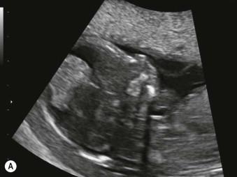 FIGURE 9-13, (A) First-trimester image of the structurally normal pump twin of a monochorionic pair complicated by twin reversed arterial perfusion sequence. (B) First-trimester image of the acardiac twin that typically presents as an amorphous and edematous mass. (C) 3D colour Doppler image of the reversed flow from the cord of the healthy pump twin (large arrow) towards the cord of the acardiac co-twin (thin arrow). (D) Radiofrequency ablation as a means to arrest the flow in a twin reversed arterial perfusion sequence. The device is positioned under ultrasound guidance in the acardiac twin near the cord insertion.