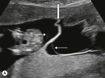 FIGURE 9-2, (A) Ultrasound image in the first trimester of a dichorionic diamniotic twin pregnancy. The twins are separated by a thick layer of fused chorionic membranes (large arrow) with two thin amniotic layers (thin arrows) on each side. (B) Ultrasound image in the first trimester of a monochorionic diamniotic twin pregnancy. The twins are separated by only two thin amniotic layers (thin arrows). (C) Ultrasound image in the first trimester of a monochorionic monoamniotic twin pregnancy. There is no separation between the twins and the single amniotic membrane (thin arrows) encircles both twins.