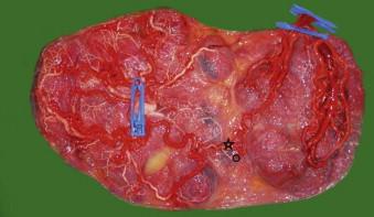 FIGURE 9-3, Bilobar monochorionic placenta with an anterior and posterior part. There was one large arterioarterial anastomosis (star) and a small arteriovenous connection (circle). The pregnancy was uncomplicated and delivery was at 35 weeks. Twin 1 weighed 2140 g and twin 2 weighed 2120 g.