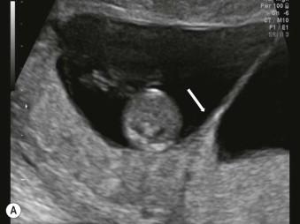 FIGURE 9-4, (A) Image of the twin peak sign or full lambda sign in the first trimester, typical for a dichorionic twin pregnancy and caused by close apposition of the chorionic discs. (B) Image of the ‘empty’ lamda sign as seen in monochorionic diamniotic pregnancies in the first trimester, caused by close apposition of the two amniotic sacs.