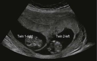 FIGURE 9-5, First-trimester image of a dichorionic twin pregnancy obtained by a transverse section. The twin on the maternal right is labeled as twin 1, whereas the twin on the maternal left is labeled as twin 2.