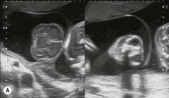 FIGURE 9-6, (A) First-trimester image of acrania in one of dichorionic twins. (B) First-trimester image of a small omphalocoele in one of dichorionic twins. (C) First-trimester image of megacystis and single umbilical artery in one of monoamniotic twins. (D) First-trimester image of an overriding aorta and right arch in one of monochorionic diamniotic twins. (E) First-trimester diagnosis of a twin reversed arterial perfusion sequence in one of monochorionic diamniotic twins.