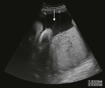 FIGURE 9-7, Illustration of the intertwin septum of a monochorionic diamniotic twin pair with measurement of the vertical pockets. The fact that there is fluid on both sides rules out a twin–twin transfusion syndrome.