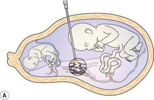 FIGURE 9-8, (A) Fetoscopic laser coagulation of the vascular anastomoses. Entry is always in the sac of the recipient and as perpendicular as possible to the vascular anastomoses. (B) Fetoscopic image of an arteriovenous anastomosis. The vein is bright red and carries oxygen-rich blood, whereas the artery is dark blue as it transports deoxygenated blood.