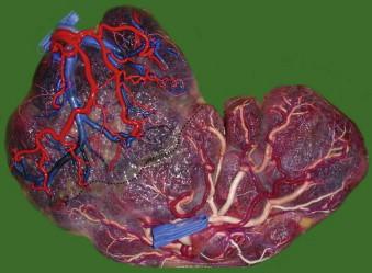 FIGURE 9-9, Typical placenta after a successful fetoscopic laser coagulation for twin–twin transfusion syndrome. The procedure was done at 20 weeks and the patient delivered at 36 weeks. Twin 1 weighed 2450 g and twin 2 weighed 2700 g. There are no anastomoses left and the line of coagulation (dotted line) is visible in between the two parts.