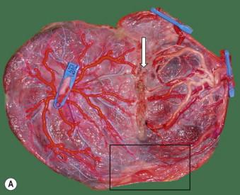 FIGURE 9-10, (A) Placenta after fetoscopic laser coagulation for twin–twin transfusion syndrome at 21 weeks complicated by a mild twin-anaemia polycythemia sequence at birth because of one tiny velamentous arteriovenous anastomosis that was missed (boxed area). The line of coagulation is visible on the chorionic surface (large arrow). Delivery was by an emergency Cesarean section at 31 weeks with the birth of an anemic ex-recipient (twin 1: 1550 g-Hb: 9 g/dL) and a polycythemic ex-donor (twin 2: 750 g-Hb: 18 g/dL). (B) Detail of the small missed velamentous anastomosis.