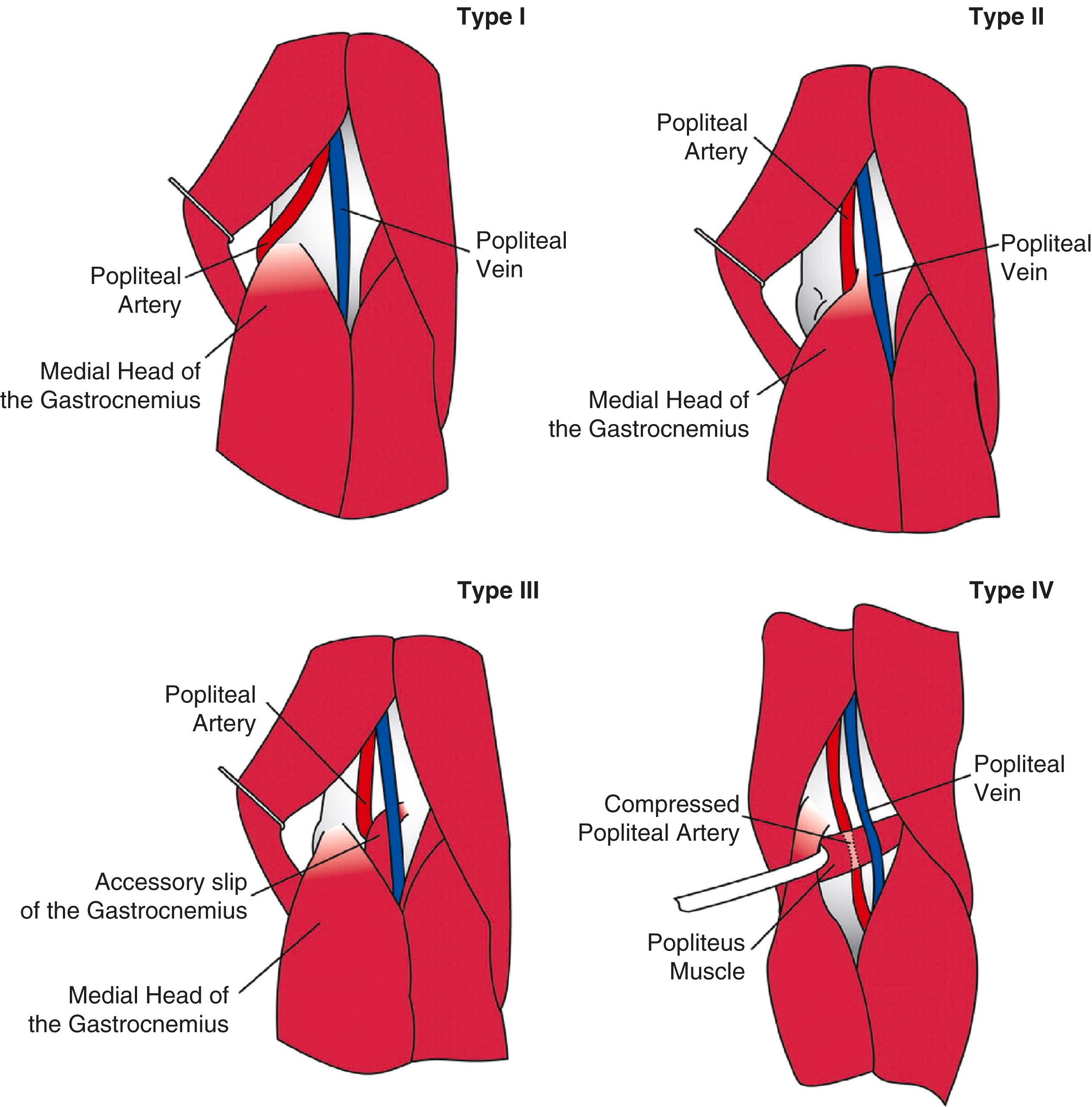 Figure 2.1, Types of popliteal entrapment syndrome showing anatomical variation in the course of the popliteal artery in relation to the medial head of gastrocnemius. 52