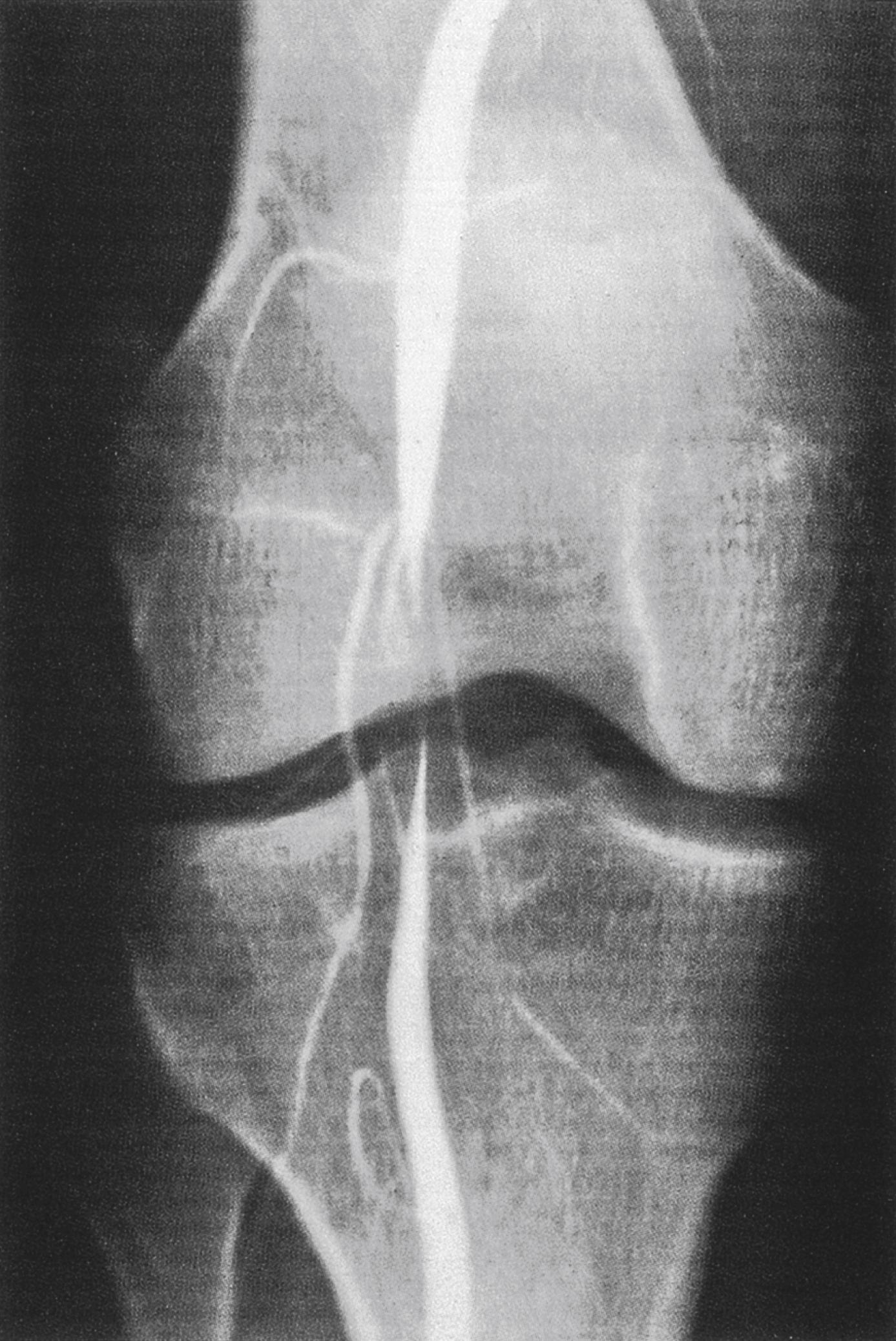 Figure 2.2, Smooth ‘hourglass’ stenosis of popliteal artery caused by cystic adventitial disease. A similar appearance may be seen in popliteal entrapment, especially during active plantar flexion.