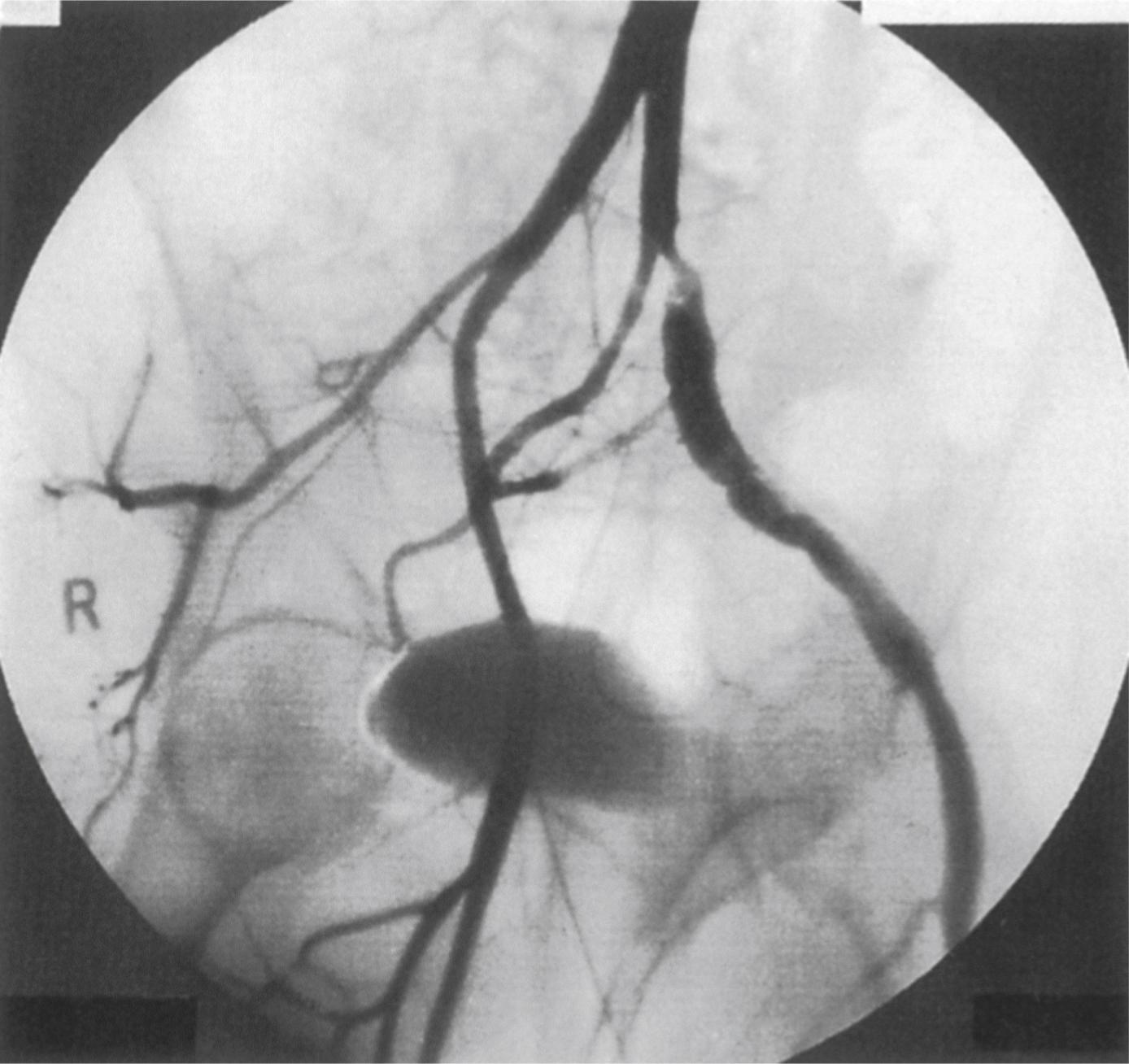 Figure 2.4, Fibromuscular dysplasia affecting the left external iliac artery of a 12-year-old boy.