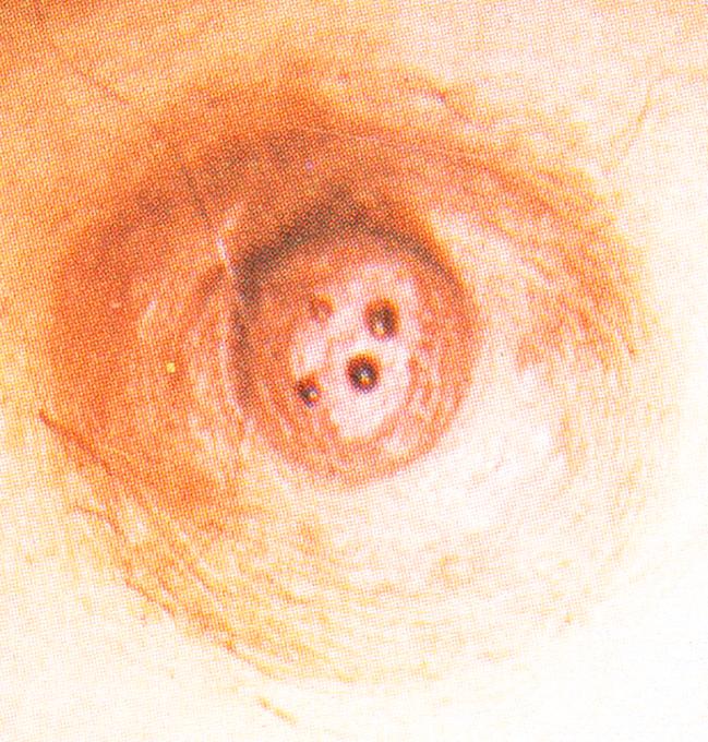 Figure 2.5, Physiological multiple duct discharge.