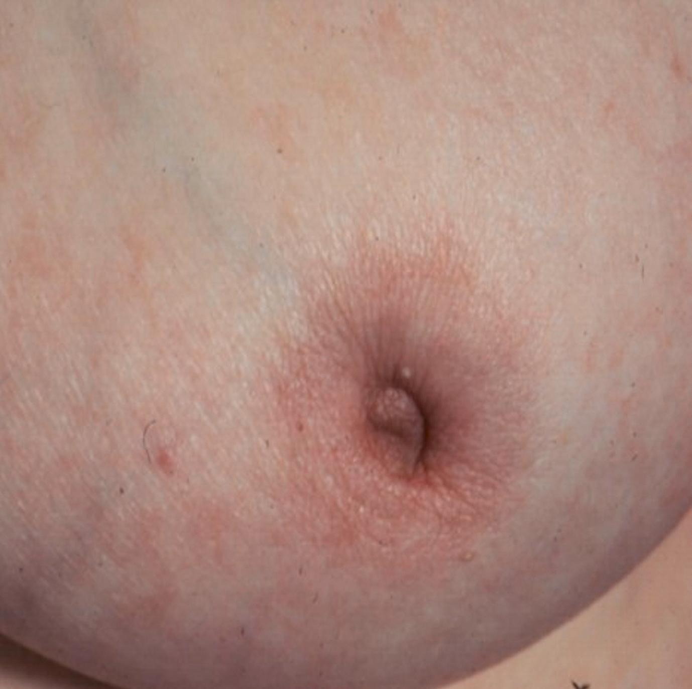 Figure 2.8, Malignant nipple retraction.