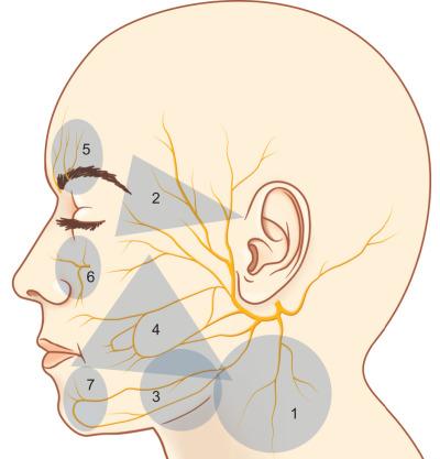 Fig. 1.1.3, Facial anatomic zones in which major facial nerve branches are susceptible to injury. Zone 1 – great auricular nerve; Zone 2 – temporal branch of VII; Zone 3 – marginal mandibular branch of VII; Zone 4 – zygomatic and buccal branches of VII; Zone 5 – supraorbital and supratrochlear nerves of V 1 ; Zone 6 – infraorbital nerve of V 2 ; Zone 7 – mental nerve of V 3 .