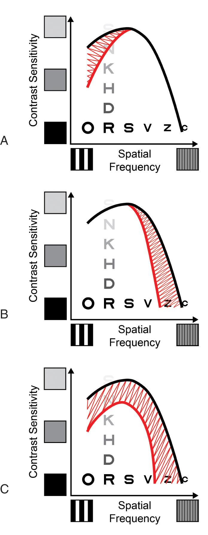 Fig. 3.6, The contrast sensitivity (CS) function of contrast threshold versus spatial frequency can be assessed by a measurement of distance visual acuity (VA) and near-peak letter CS. (A) Normal VA but reduced near-peak CS. (B) Reduced VA but normal near-peak CS. (C) the same reduced VA as B, but with reduced near-peak CS.