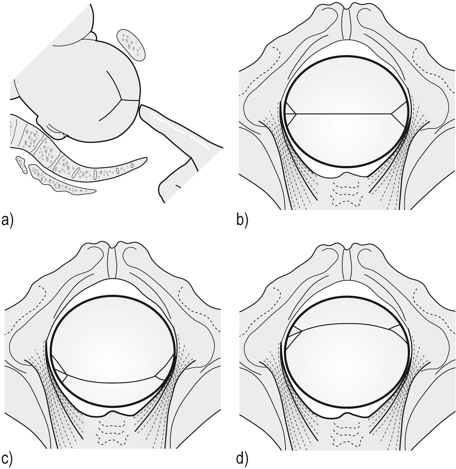 FIG. 18.2, Synclitism and asynclitism. (a) Detection of asynclitism, estimating how far from the symphysis the sagittal suture lies. (b) Left occipitotransverse (LOT) normal synclitism, both parietal bones present equally. (c) LOT anterior asynclitism, anterior parietal presentation. (d) LOT posterior asynclitism, posterior parietal presentation.