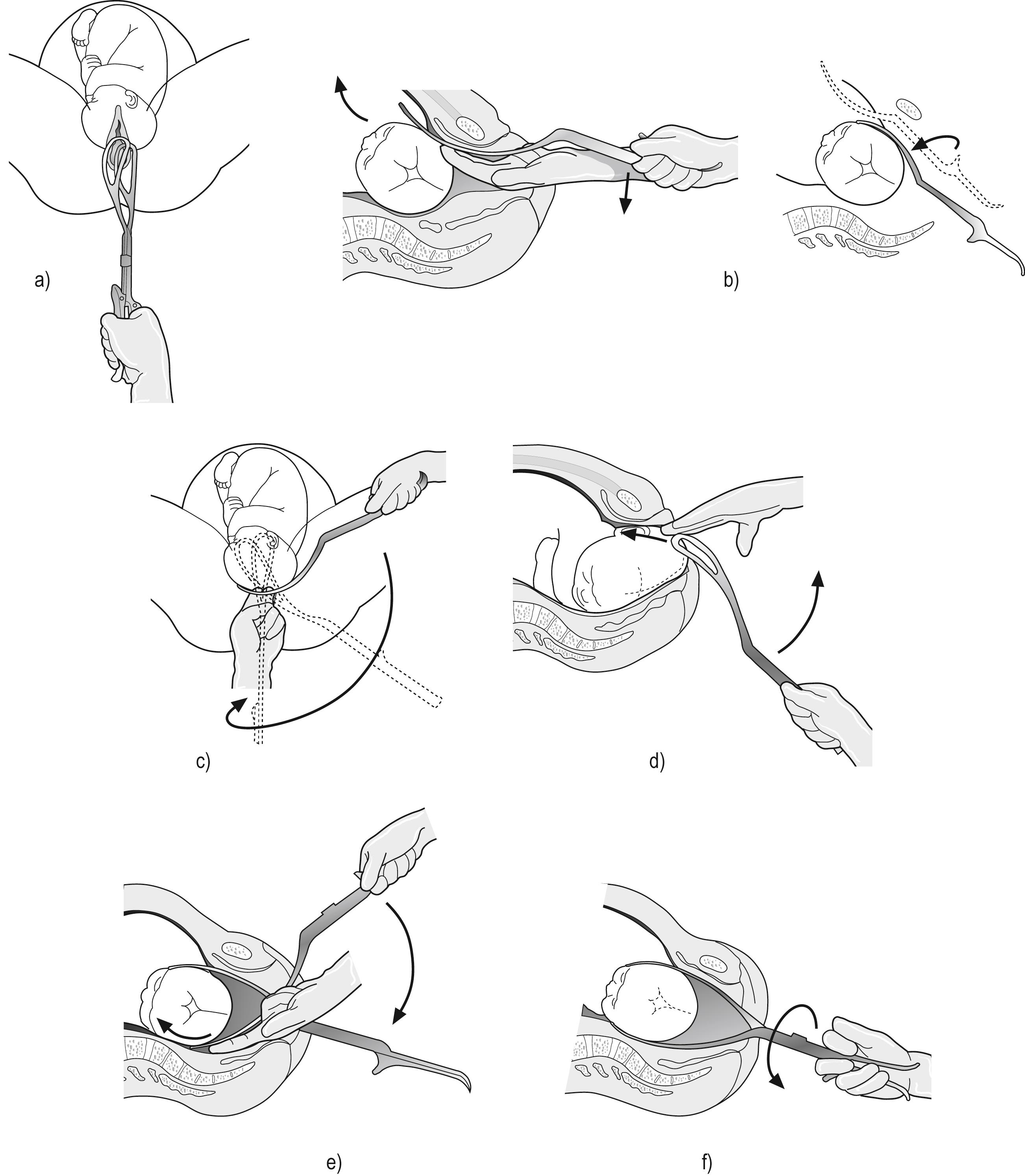 FIG. 18.3, Kielland’s forceps application: left occipitotransverse (LOT). (a) Orientating the assembled forceps – directional knobs towards the occiput. (b) ‘Classical’ or high insertion method (historical) – anterior blade inserted ‘tip to umbilicus’, then rotated and brought down to fetal head. (c) Wandering technique for applying anterior blade. (d) Direct application technique for anterior blade. (e) Posterior blade introduced directly. (f) Gentle rotation from LOT to occipitoanterior.