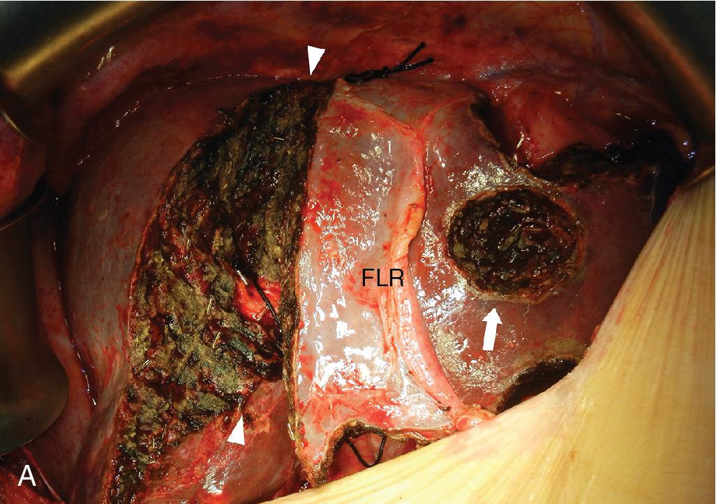 FIGURE 123.1, Surgical photographs of the ALPPS procedure in a patient with bilateral colorectal liver metastases.