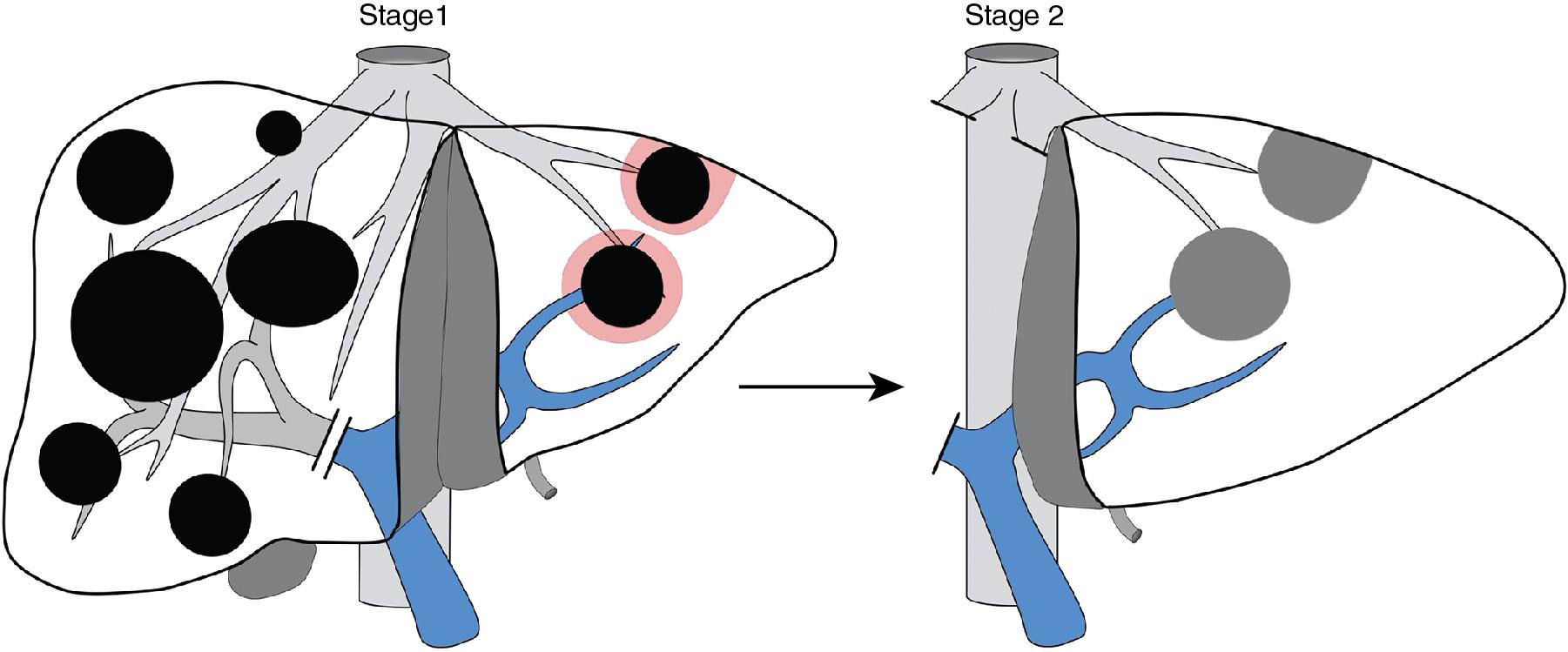 FIGURE 123.2, Diagram detailing both stages of ALPPS.