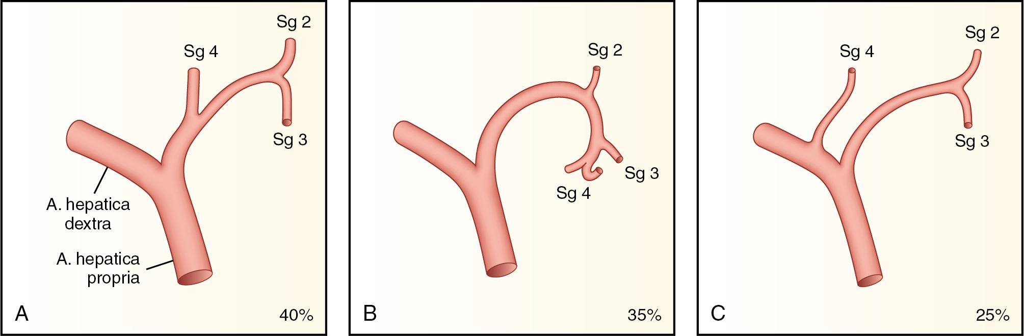 FIGURE 123.4, Arterial vascularization variants of segment (Sg) IV.