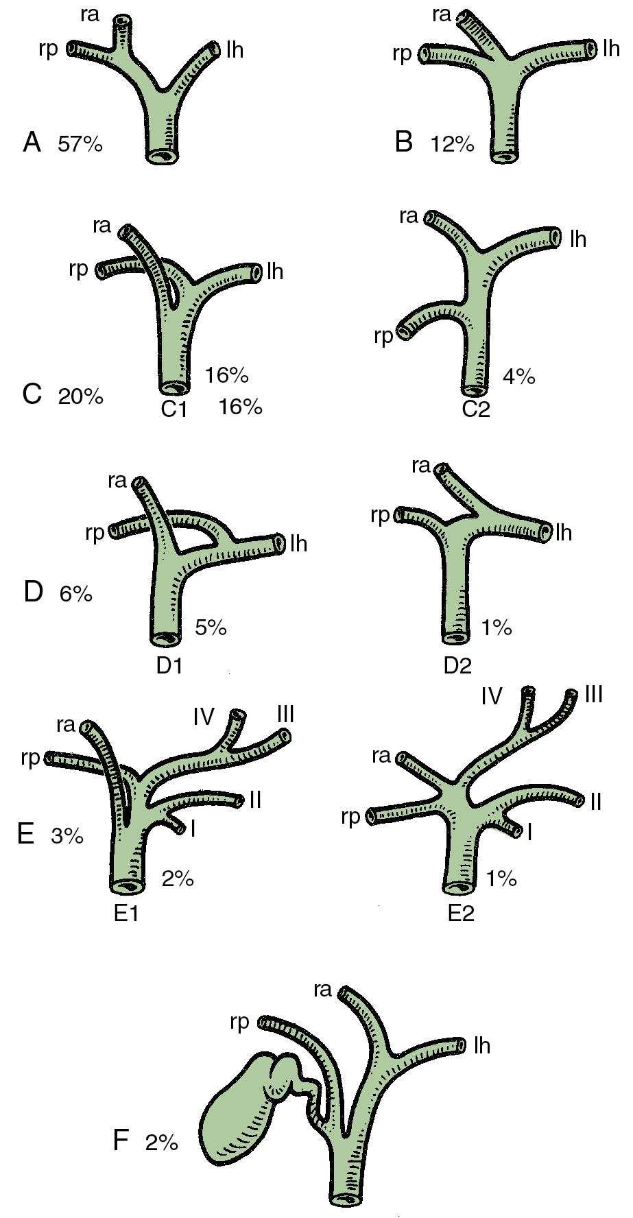 FIGURE 123.6, Variations of segment IV biliary drainage (see Chapter 2 ).
