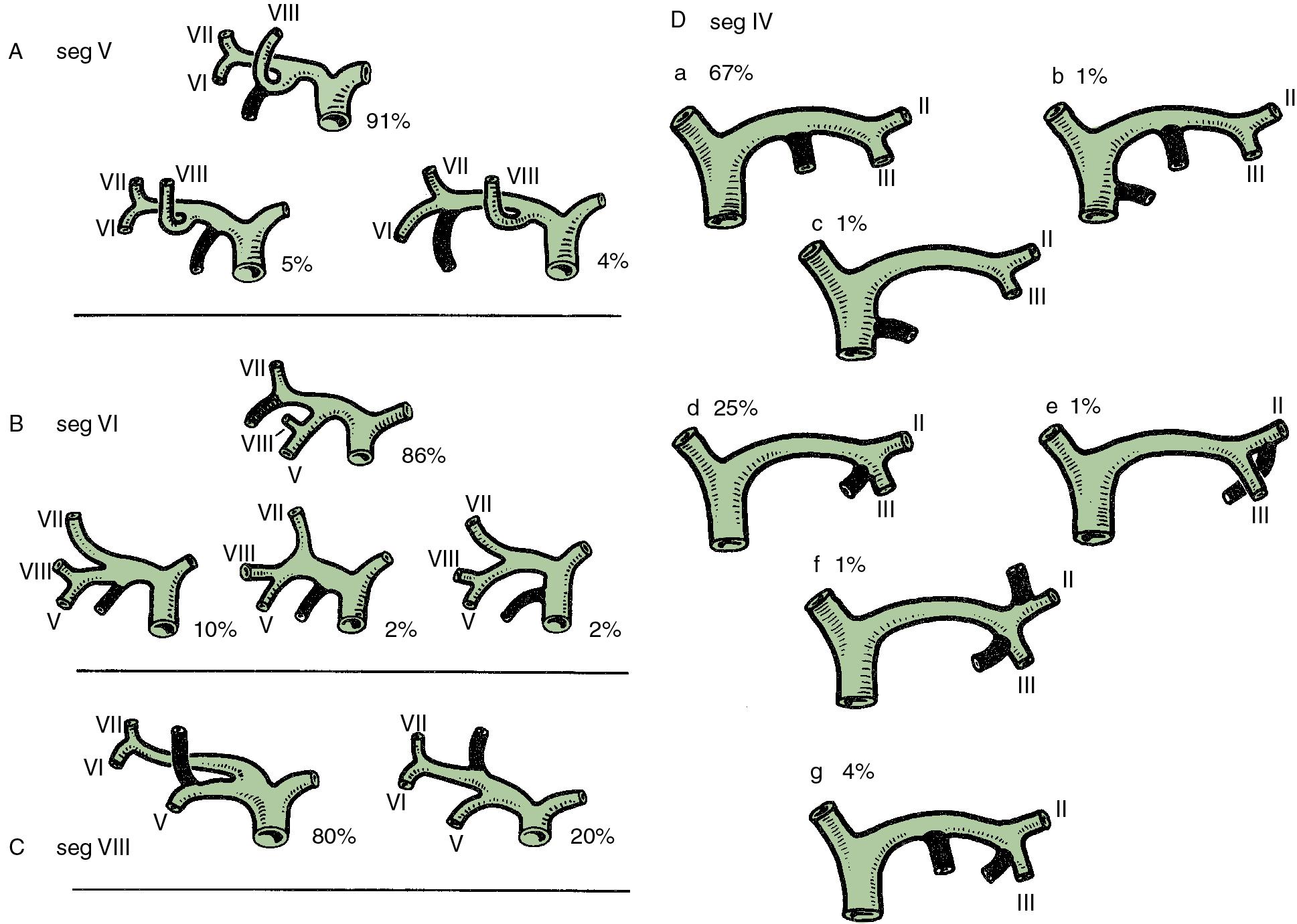 FIGURE 123.7, Main variations of the hepatic duct confluence (see Chapter 2 ).