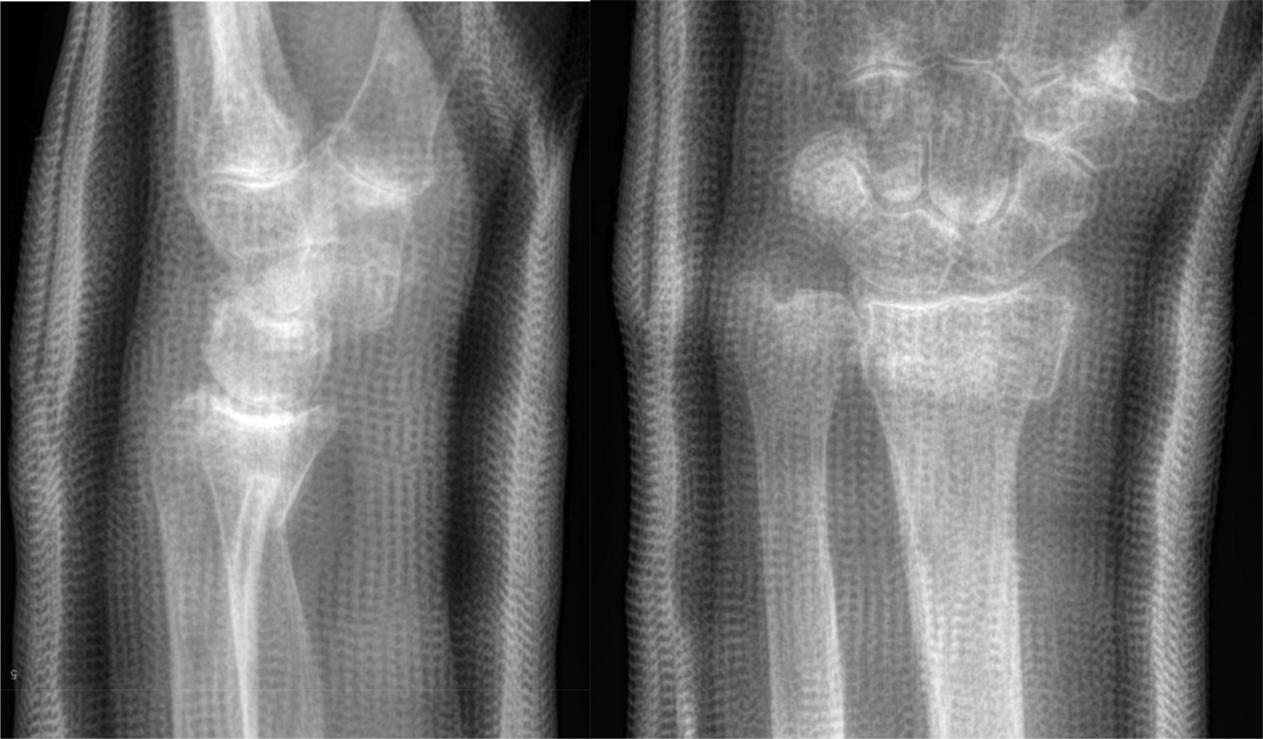 Fig. 1, Postreduction radiographs.