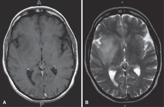 Fig. 6.1, Diffuse astrocytoma, WHO grade II on MRI. (A) T1-weighted MRI with gadolinium reveals a subtle area of low signal intensity in the right frontoparietal basal ganglia, white matter, and cortical regions. (B) This same region is much better visualized by its increased signal intensity on T2-weighted MRI. Note the ill-defined margins.